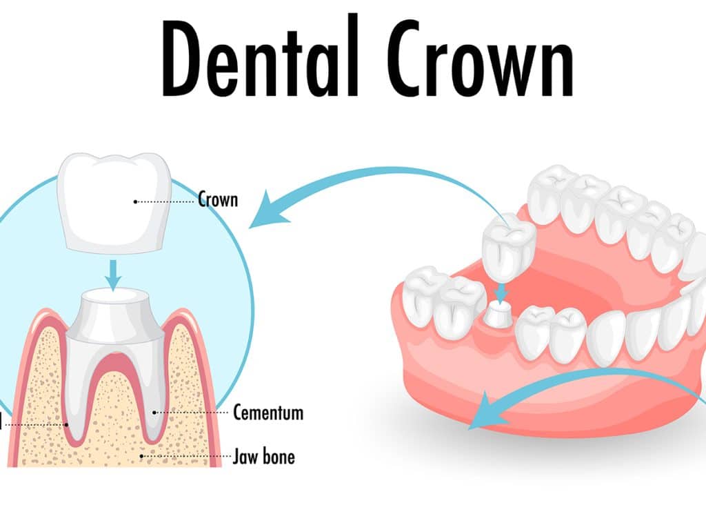 Dental Crown