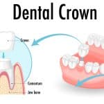 Dental Crown