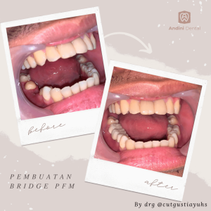 Before & After Bridge/Crown
