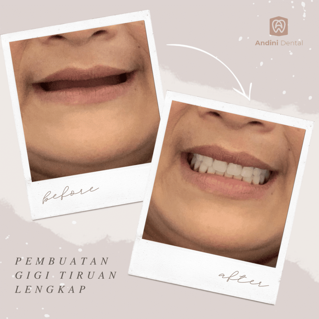 Gigi Tiruan Lengkap