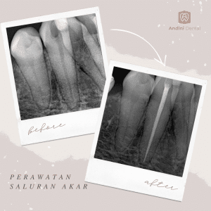 Perawatan Saluran Akar
