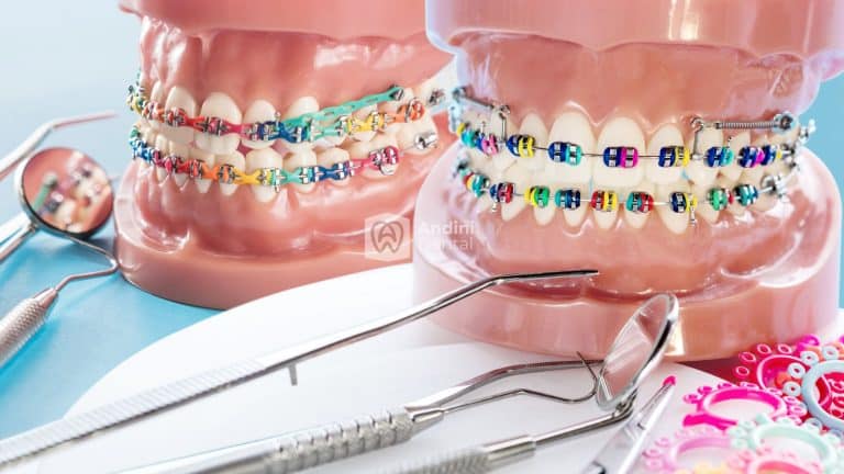 Tipe-Tipe Gigi yang Membutuhkan Perawatan Behel