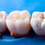 Tambalan sementara gigi