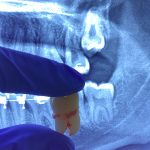 Gigi Bungsu: Dicabut atau Dibiarkan