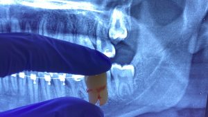 Gigi Bungsu: Dicabut atau Dibiarkan